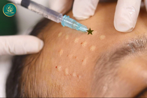 KHÓA HỌC CẤY MESO CĂNG BÓNG – BÍ QUYẾT TRẺ HÓA LÀN DA TỪ BÊN TRONG