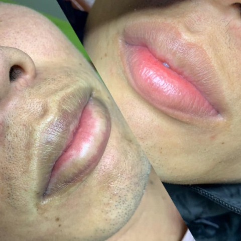 KHỬ THÂM MÔI TẬN GỐC - ĐIỀU TRỊ THÂM MÔI BẰNG CÔNG NGHỆ LASER CO2