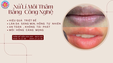 PHUN MÔI VÀ KHỬ THÂM MÔI KHÁC NHAU Ở ĐIỂM NÀO ? KHỬ THÂM MÔI BẰNG LASER AN TOÀN HIỆU QUẢ