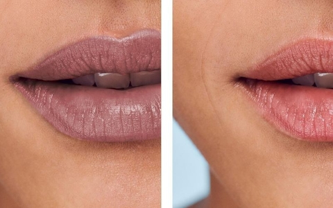 KHỬ THÂM MÔI BẰNG LASER LÀ GÌ ? TRỊ THÂM MÔI TẬN GỐC BẰNG LASER