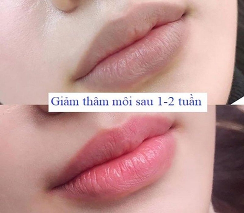 KHỬ THÂM MÔI KHÔNG PHUN MÀU - PHƯƠNG PHÁP KHỬ THÂM MÔI BẰNG LASER CO2 FRACTIONAL