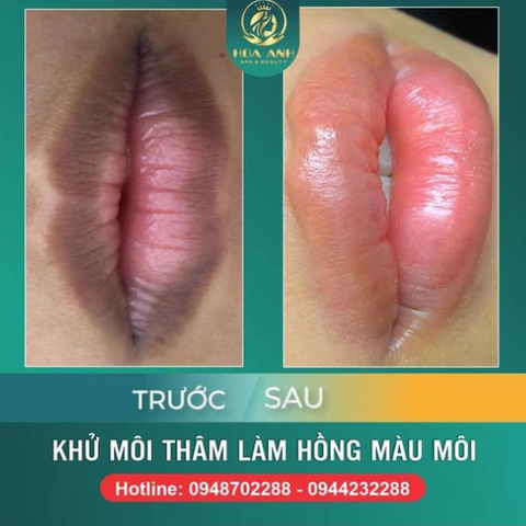 KHÓA HỌC KHỬ THÂM MÔI