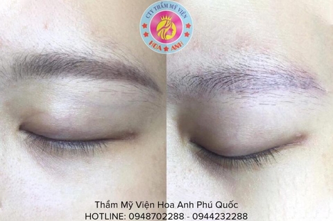 VÌ SAO CHÂN MÀY BỊ TRỔ XANH, ĐỎ ? CÁCH SỬ LÝ CHÂN MÀY TRỔ ĐỎ HIỆU QUẢ NHẤT