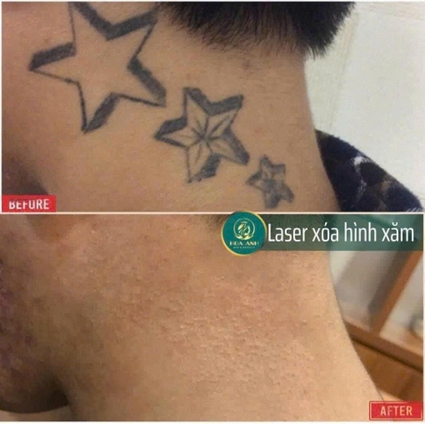 KHÓA HỌC XÓA HÌNH XĂM – CƠ HỘI LÀM CHỦ CÔNG NGHỆ LASER HIỆN ĐẠI