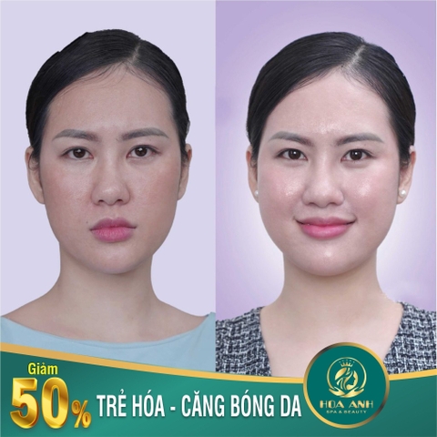 TIÊM MESO CĂNG BÓNG DA LÀ GÌ ? TIÊM MESO CĂNG BÓNG DA GIỮ ĐƯỢC BAO LÂU