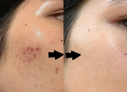 ĐIỀU TRỊ MỤN HẾT SẠCH THÂM - PHƯƠNG PHÁP ĐIỀU TRỊ MỤN HIỆU QUẢ