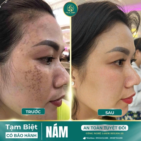 KHÓA HỌC ĐIỀU TRỊ NÁM BẰNG CÔNG NGHỆ LASER – CƠ HỘI CHO SPA PHÁT TRIỂN VƯỢT BẬC