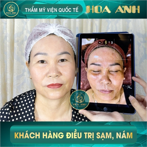 Khóa Học Điều Trị Nám Chuyên Sâu - Giải Pháp Hiệu Quả Cho Da Khỏe Đẹp