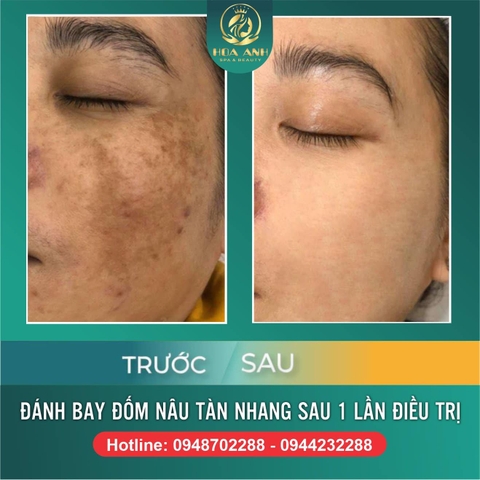 NÁM DA LÀ GÌ ? DẤU HIỆU NHẬN BIẾT BẠN ĐANG BỊ NÁM DA