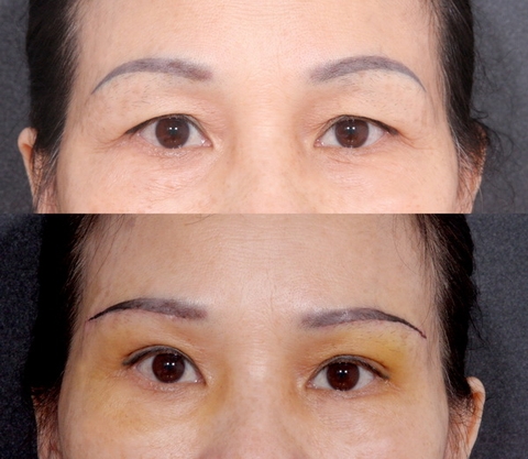 NÂNG CUNG CHÂN MÀY LÀ GÌ ? NÂNG CUNG CHÂN MÀY BAO LÂU THÌ LÀM LẠI ĐƯỢC