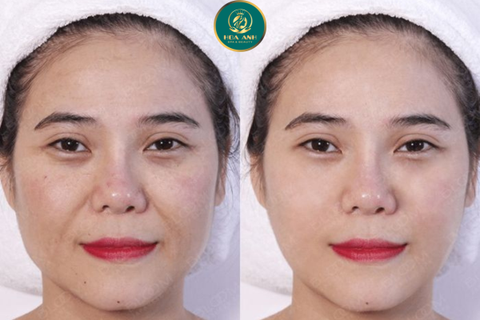 KHÓA HỌC NÂNG CƠ BẰNG CÔNG NGHỆ HIFU – ĐỘT PHÁ TRONG TRẺ HÓA DA