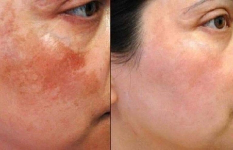 PEEL DA TRỊ NÁM LÀ GÌ ? PEEL DA TRỊ NÁM CÓ AN TOÀN KHÔNG ?