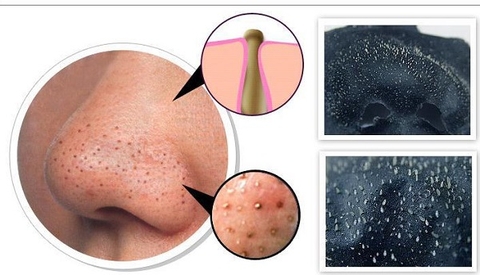 PHÂN BIẾT SỢI BÃ NHỜN - MỤN ĐẦU ĐEN VÀ GIẢI PHÁP ĐIỀU TRỊ