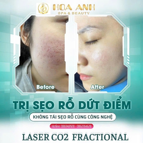 KHÓA HỌC ĐIỀU TRỊ SẸO RỖ