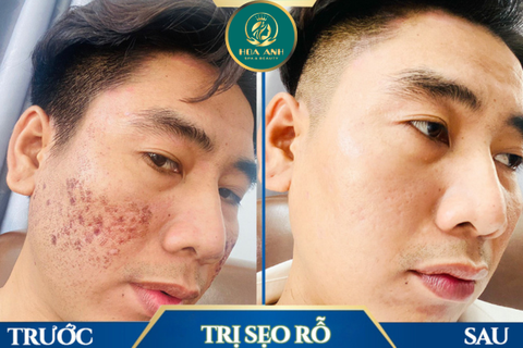 KHÓA HỌC CHUYÊN SÂU: ĐIỀU TRỊ SẸO RỖ HIỆU QUẢ – CHÌA KHÓA CHO SỰ NGHIỆP VỮNG CHẮC