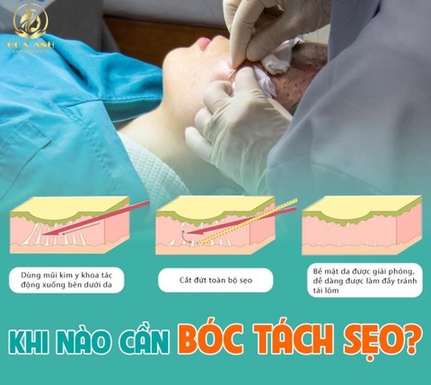 ĐIỀU TRỊ SẸO RỖ BẰNG PHƯƠNG PHÁP BÓC TÁCH ĐÁY SẸO AN TOÀN