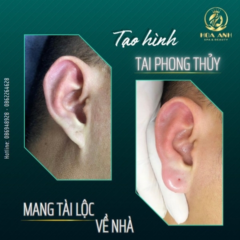 TIÊM TAI TÀI LỘC LÀ GÌ ? LÀM SAO ĐỂ SỞ HỮU TAI TÀI LỘC NHANH CHÓNG