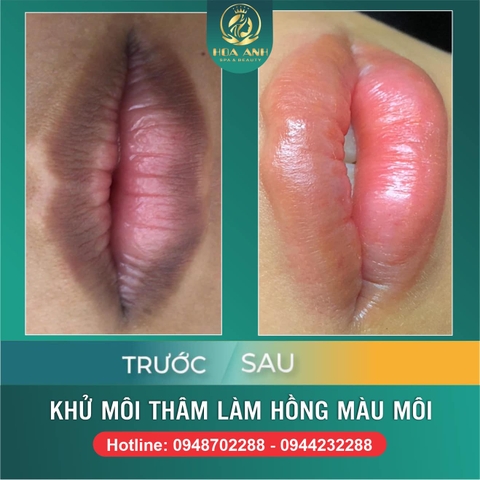 TRỊ THÂM MÔI BẰNG LASER LÀ GÌ ? TRỊ THÂM MÔI BẰNG LASER CÓ HẾT KHÔNG