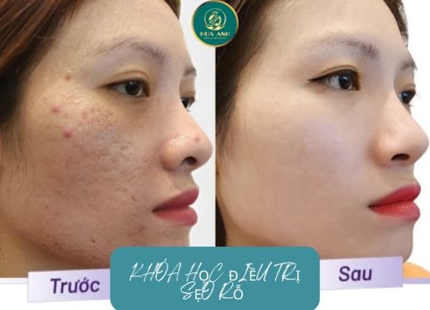 Khóa Học Điều Trị Sẹo Rỗ