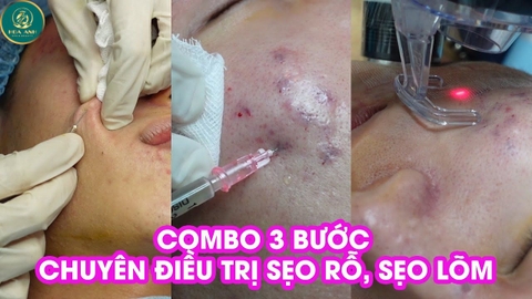 KHÓA HỌC ĐIỀU TRỊ SẸO RỖ