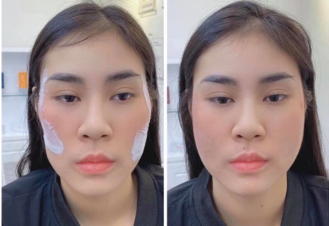 TIÊM FILLER MÁ BABY GIỮ ĐƯỢC BAO LÂU, CÓ ẢNH HƯỞNG GÌ KHÔNG ?