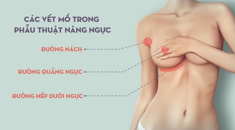 TIÊM FILLER LÀM ĐẦY NGỰC LÀ GÌ ? TIÊM FILLER LÀM ĐẦY NGỰC CÓ AN TOÀN KHÔNG ?