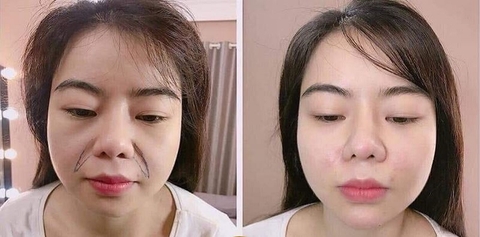 TIÊM FILLER XÓA RẢNH CƯỜI GIỮ ĐƯỢC BAO LÂU ? TIÊM XÓA RẢNH CƯỜI TỰ NHIÊN