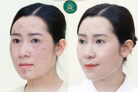 KHÓA HỌC CẤY MESO CĂNG BÓNG DA – BÍ QUYẾT ĐỂ TRỞ THÀNH CHUYÊN GIA TRONG NGÀNH THẨM MỸ