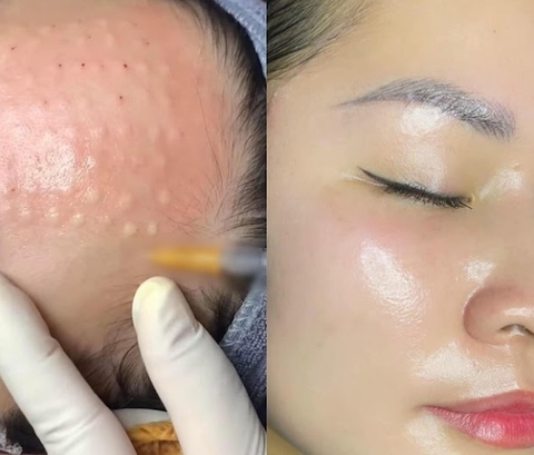 MESO THERAPY CĂNG BÓNG DA TRẺ HÓA TOÀN DIỆN, BẠN ĐÃ BIẾT CHƯA ?