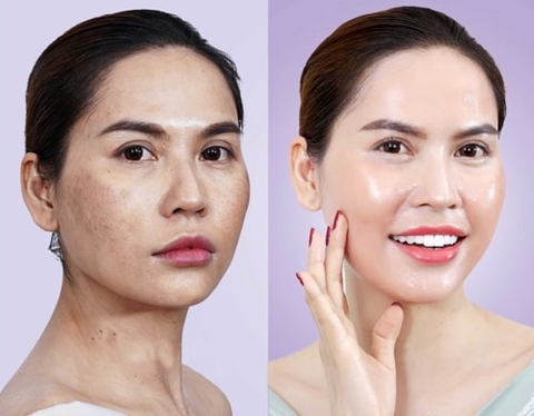 TIÊM MESO CĂNG BÓNG DA LÀ GÌ ? TÁC DỤNG VÀ LƯU Ý KHI TIÊM MESO CĂNG BÓNG DA