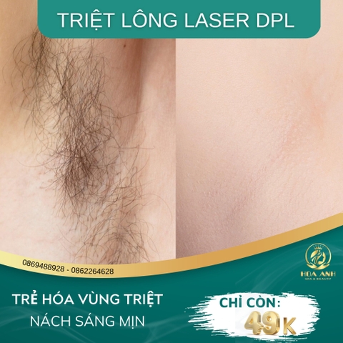 CÔNG NGHỆ TRIỆT LÔNG VĨNH VIỄN DPL CAM KẾT HẾT SẠCH HOÀN TOÀN NANG LÔNG