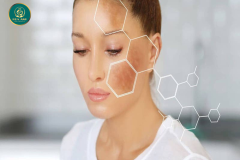 NÁM DA LÀ GÌ ? BIỆN PHÁP ĐIỀU TRỊ VÀ PHÒNG NGỪA HIỆU QUẢ