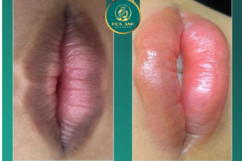 KHỬ THÂM MÔI TẬN GỐC - ĐIỀU TRỊ THÂM MÔI BẰNG CÔNG NGHỆ LASER CO2