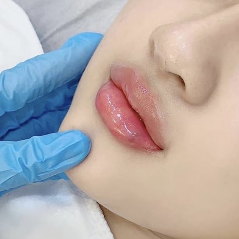 NHỮNG ĐIỀU CẦN LƯU Ý TRƯỚC KHI TIÊM FILLER MÔI ? CÁCH CHĂM SÓC MÔI SAU KHI TIÊM FILLER