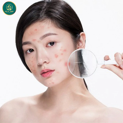 ĐIỀU TRỊ MỤN HẾT SẠCH THÂM - PHƯƠNG PHÁP ĐIỀU TRỊ MỤN HIỆU QUẢ