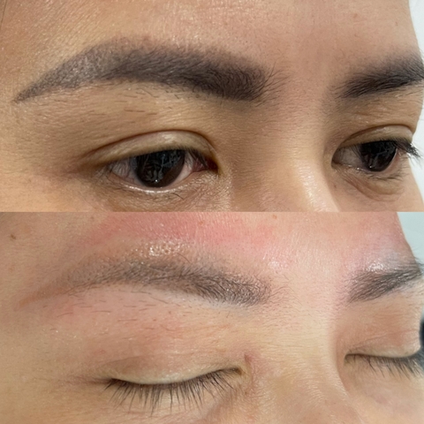 CHÂN MÀY BỊ TRỔ XANH, TRỔ ĐỎ CÓ LÀM LẠI ĐƯỢC KHÔNG ? XÓA CHÂN MÀY BẰNG LASER LÀ GÌ ?