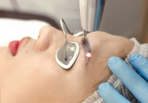 XÓA CHÂN MÀY BẰNG CÔNG NGHỆ LASER LÀ GÌ ? XÓA BẰNG CÔNG NGHỆ LASER CÓ ĐỂ LẠI SẸO KHÔNG