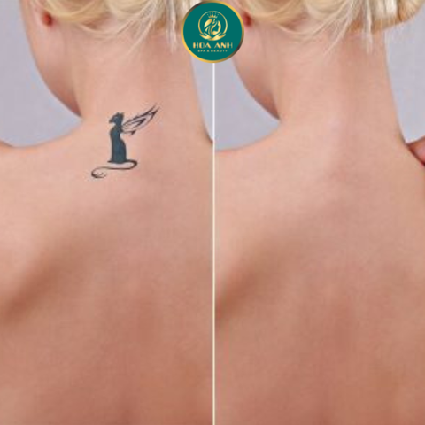 Khóa Học Xóa Xăm Bằng Công Nghệ Laser: Cơ Hội Bứt Phá Cho Các Chuyên Gia Thẩm Mỹ