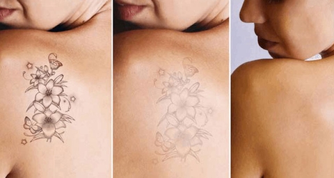 XÓA HÌNH XĂM AN TOÀN - XÓA HÌNH XĂM BẰNG LASER KHÔNG ĐỂ LẠI SẸO