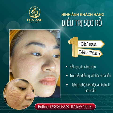 Điều trị sẹo rỗ