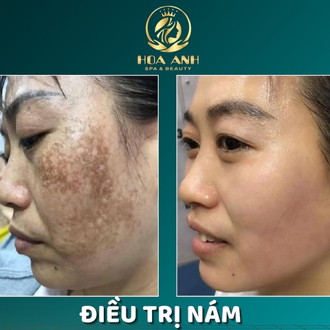 Trị nám chuẩn Y Khoa