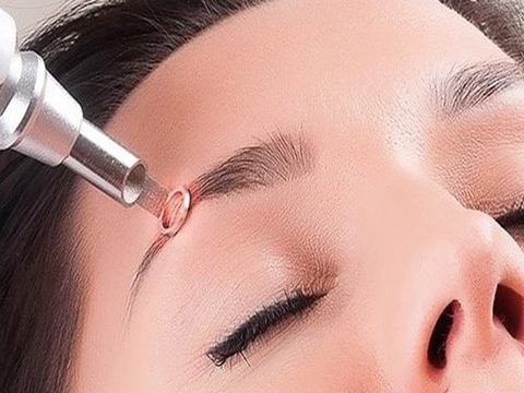 Xóa Xăm Lông Mày Như Thế Nào? Cách Chăm Sóc Sau Khi Xóa Xăm