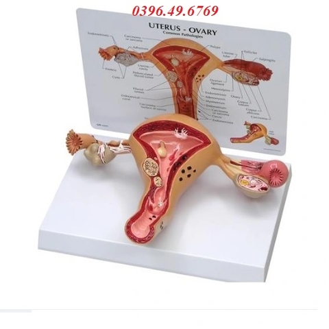 Mô hình buồng trứng và tử cung bệnh lý