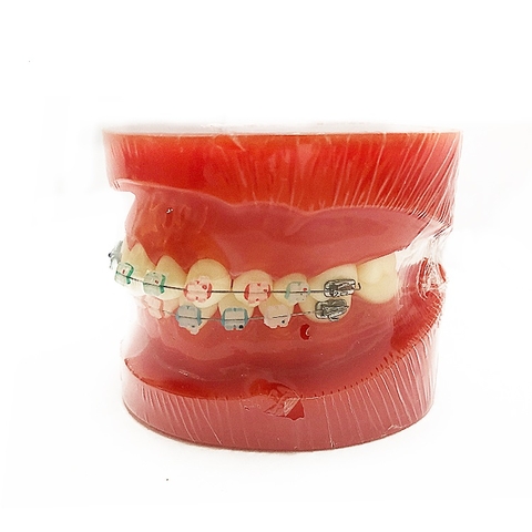 Mô hình chỉnh nha ( nửa kim loại và nửa sứ)
