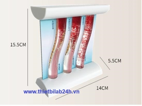 Mô hình mô phỏng mỡ máu (3 mạch máu so sánh)