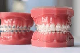 Mô hình chỉnh nha mắc cài sứ cố định