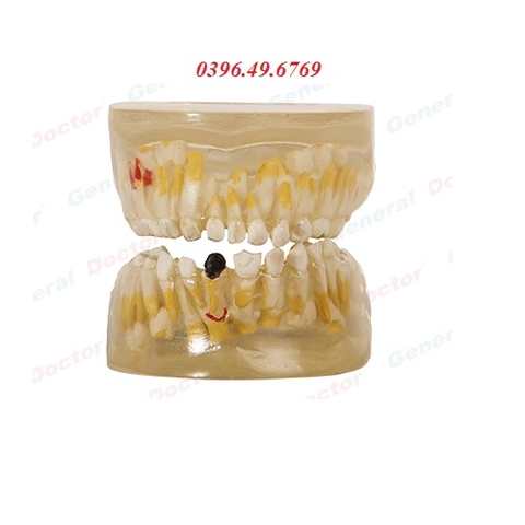 Mô hình bệnh lý răng sữa trong suốt model GD/B10013