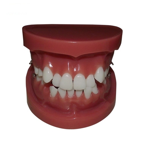 Mô hình răng trước khi chỉnh nha