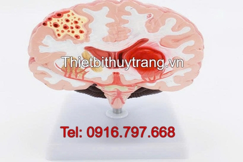 Mô Hình Đột Quỵ Não TTV36