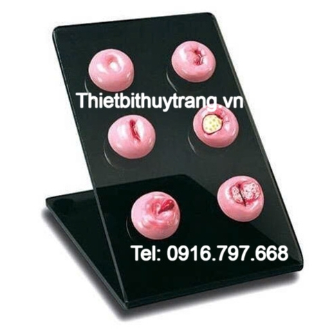 Mô Hình Mô Phỏng Cổ Tử Cung Bất Thường S505 Gaumard